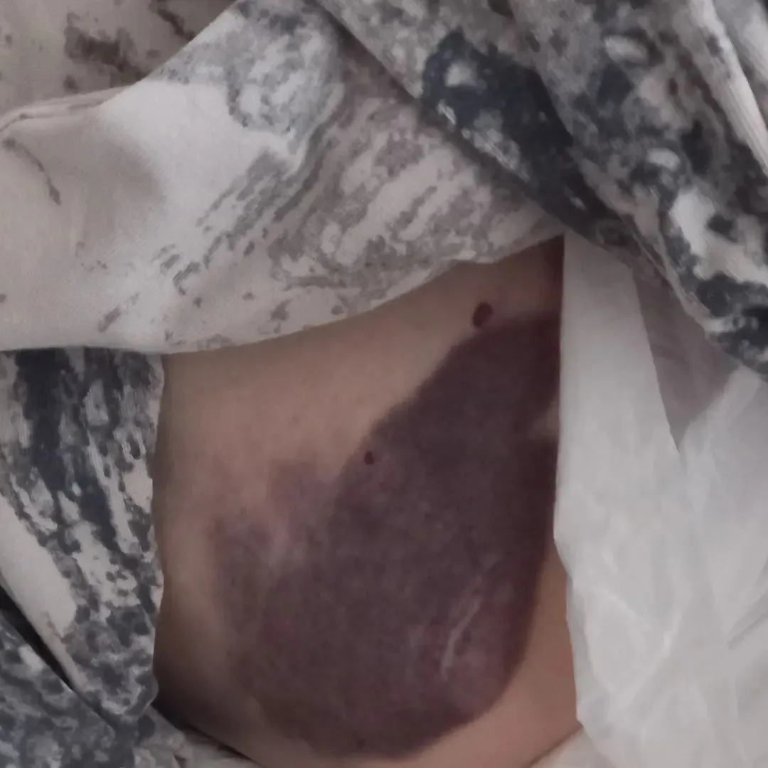 У пенсионерки синяки и гематомы dqxikeidqxiqqeant