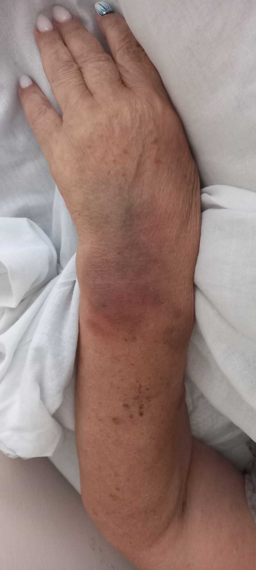 У пенсионерки синяки и гематомы