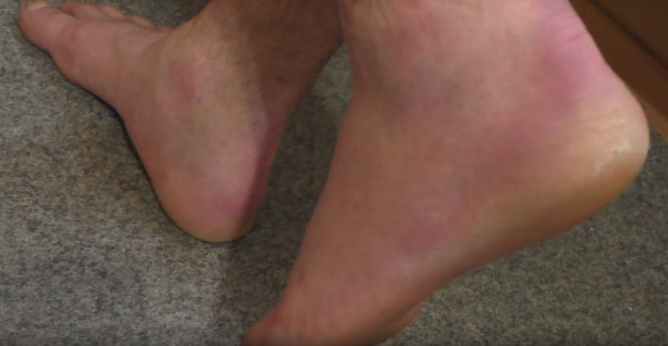 Синці на ногах