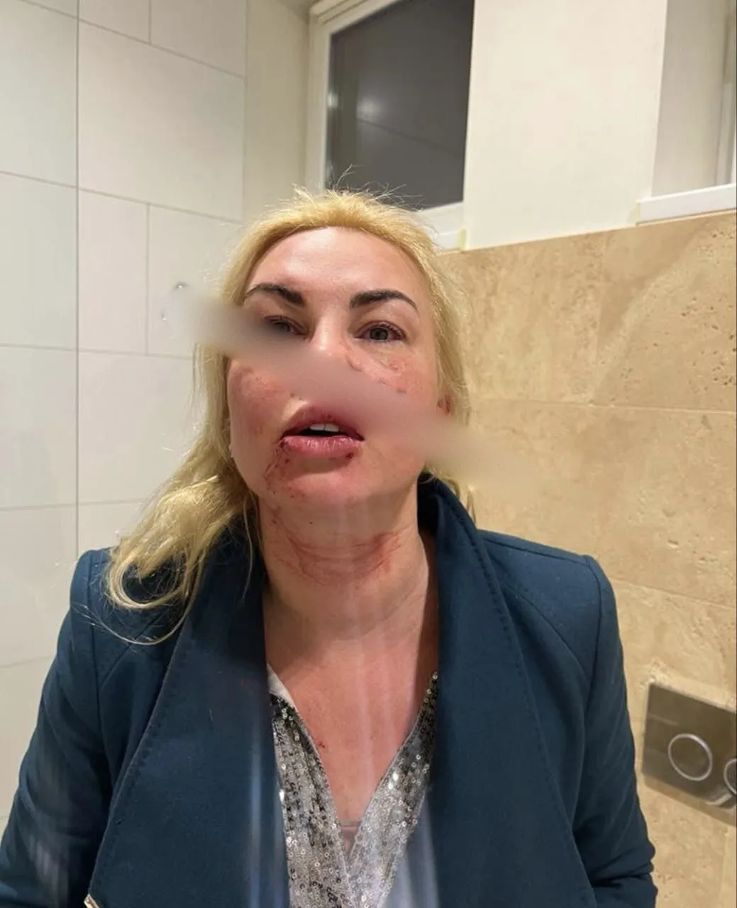 Мережу шокували фото Камалії в синцях та крові: співачка відреагувала