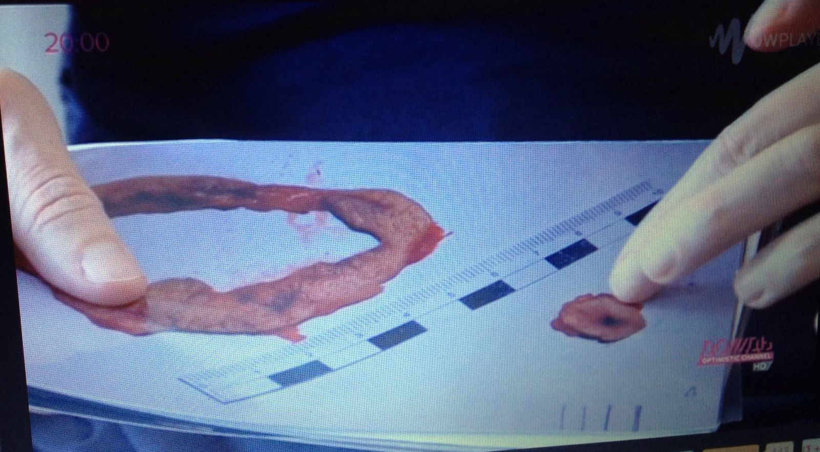 Фото места ранения, которые продемонстрировал Кернес dqxikeidqxitkant