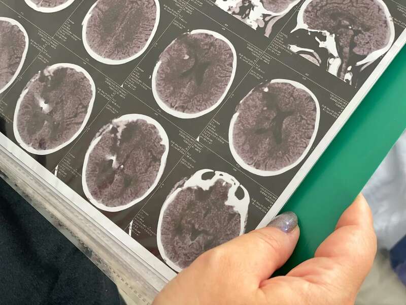 У Львові лікарі видалили уламок міни з мозку 9-річного хлопчика з Херсона: його друг під час обстрілу загинув на місці. Фото