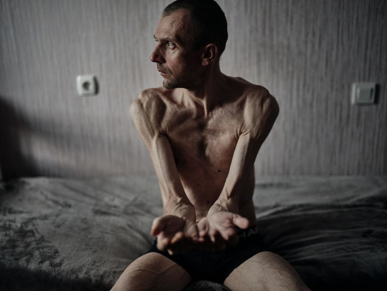 Photos of Ukrainian soldiers after captivity dqxikeidqxitkant