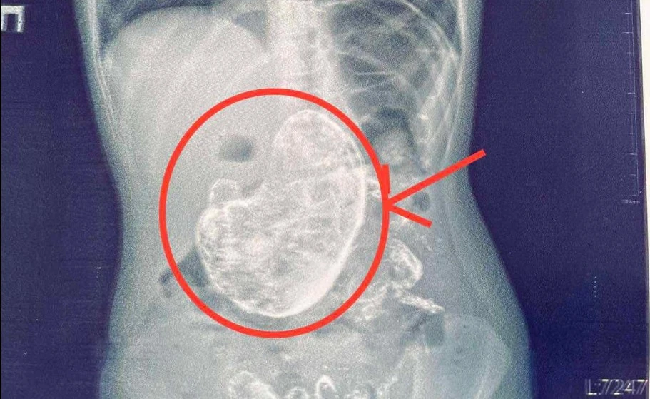 волосся у шлунку dqxikeidqxitkant