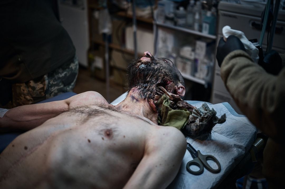 Пулевое ранение в голову, нет части челюсти: как медики спасают жизнь воинов на Кураховском направлении. Фото