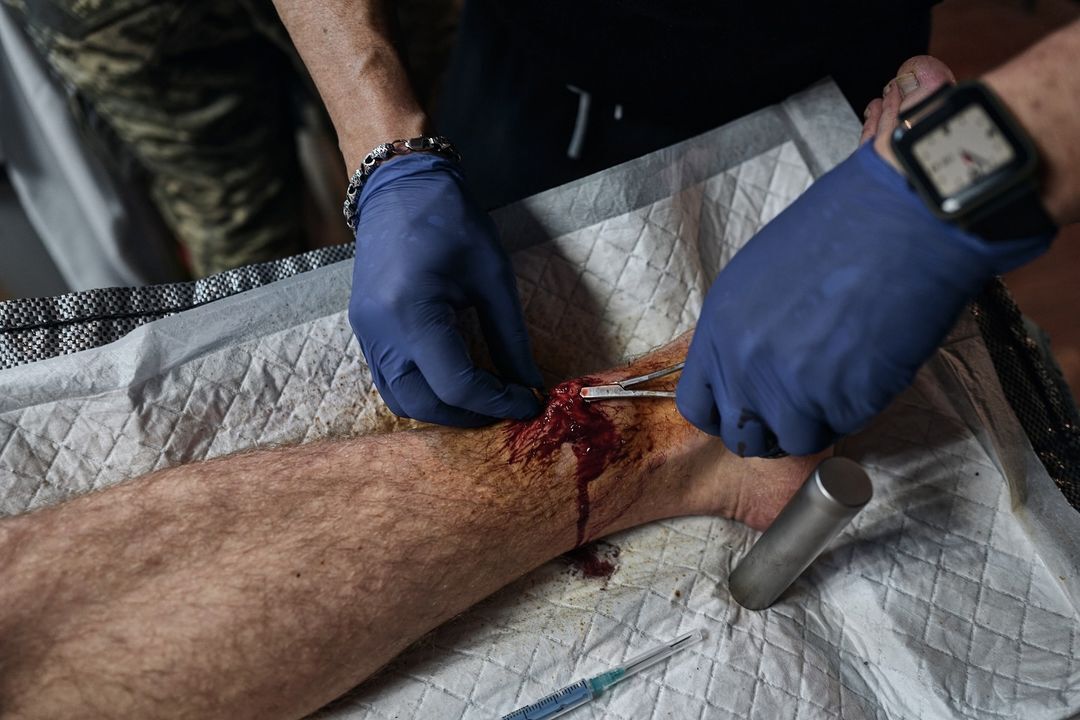 Пулевое ранение в голову, нет части челюсти: как медики спасают жизнь воинов на Кураховском направлении. Фото