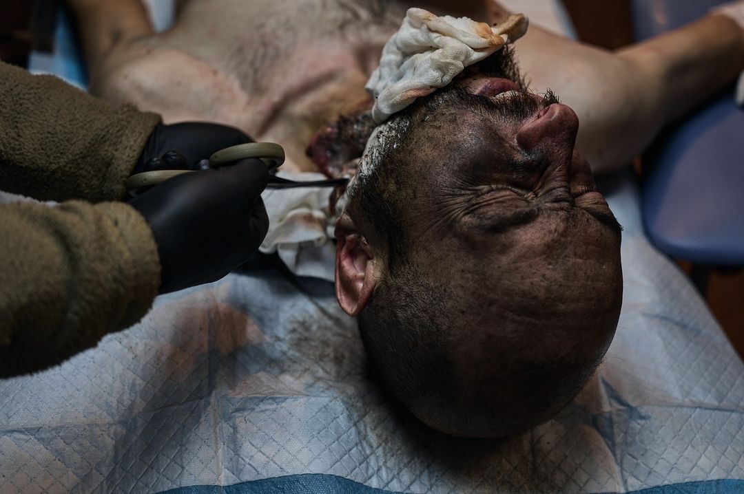 Пулевое ранение в голову, нет части челюсти: как медики спасают жизнь воинов на Кураховском направлении. Фото