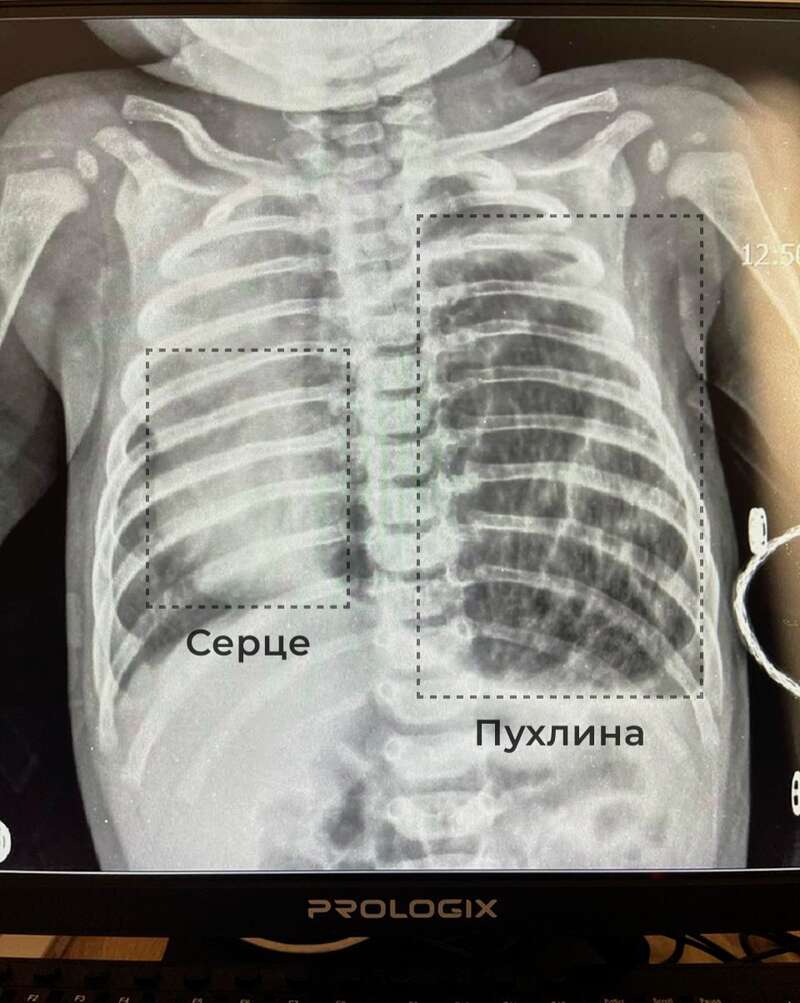 «Пухлина була розміром з долоню». У Львові медики врятували немовля фото 1 dqxikeidqxitkant