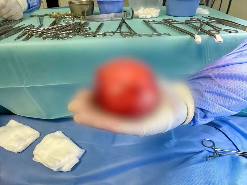 Лікар: Наша команда ледве витягнула цю пухлину через розріз, бо вона була розміром з цілу долоню. Для такого крихітного тіла це дуже багато