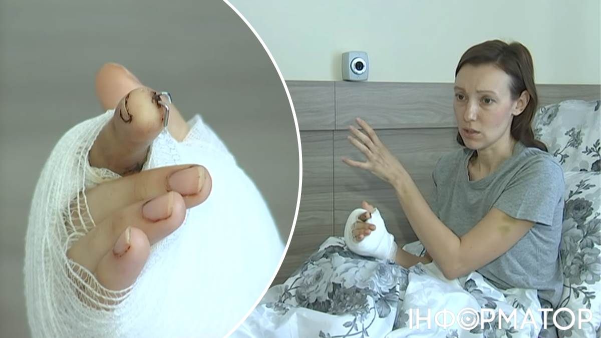 Лікарі операція пересадка пальця dqxikeidqxiqqeant